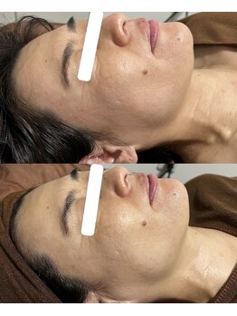 ヨルエステ(yoru aesthe)/【透明感up、首のシワケア】