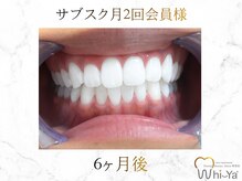 ホワイヤ セルフホワイトニング DBS神楽坂(Whi-Ya)/☆サブスク会員様☆納得の白さ☆