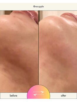 リサプリ(Re: Supple)/美容施術後のダウンタイム緩和