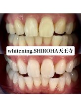 シロハ(SHIROHA)/セルフホワイトニング/天王寺