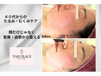 プライベートサロン やすらぎ/アライアンスフェイス症例１回