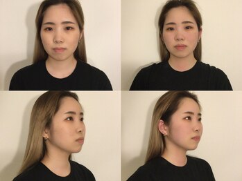 フラット(FURATTO)/Before - After【施術回数1回】