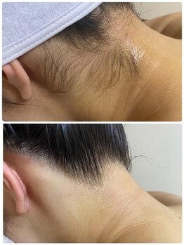 ココピュアレ(coco purele)/気になるうなじの脱毛