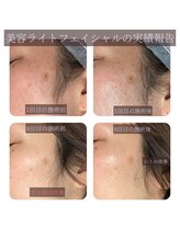 ブロッサム(BLOSSOM)/アイス美容ライトフェイシャル