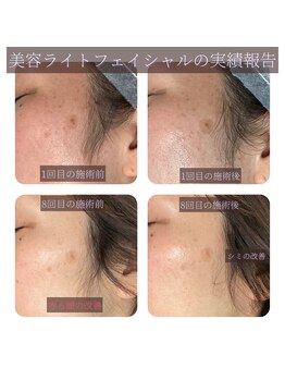 ブロッサム(BLOSSOM)/アイス美容ライトフェイシャル