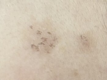 サクラ 伊勢原店(SAKURA)/悩んでいたシミケアを垢化し排出