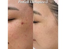 叶(Kanau)/プロセルセラピーズ