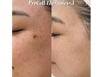 叶(Kanau)/プロセルセラピーズ