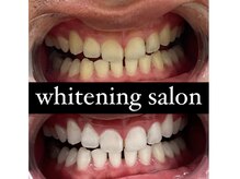 チェルト 鈴鹿店(CERTO)/セルフホワイトニング効果★