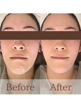 凪眠/小顔リンパフェイシャルの効果33