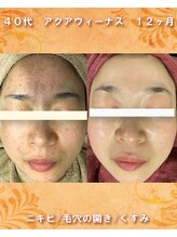 ナイア(naia)/アクアヴィーナス使用症例