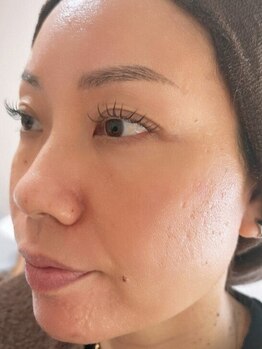 サロン ベレ プー(Salon Belle Peau)の写真/【毛穴改善スペシャル】毛穴洗浄×ハーブピーリング90分￥7980♪徹底的に毛穴改善したい方におススメ☆