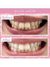エクシアホワイトニング 奥田店/ホワイトニングビフォーアフター
