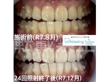 ホワイトニングサロン 福岡天神店/ホワイトニング