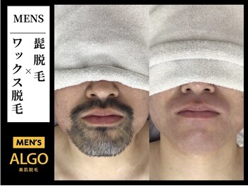 アルゴ 小倉守恒店(ALGO)/髭脱毛