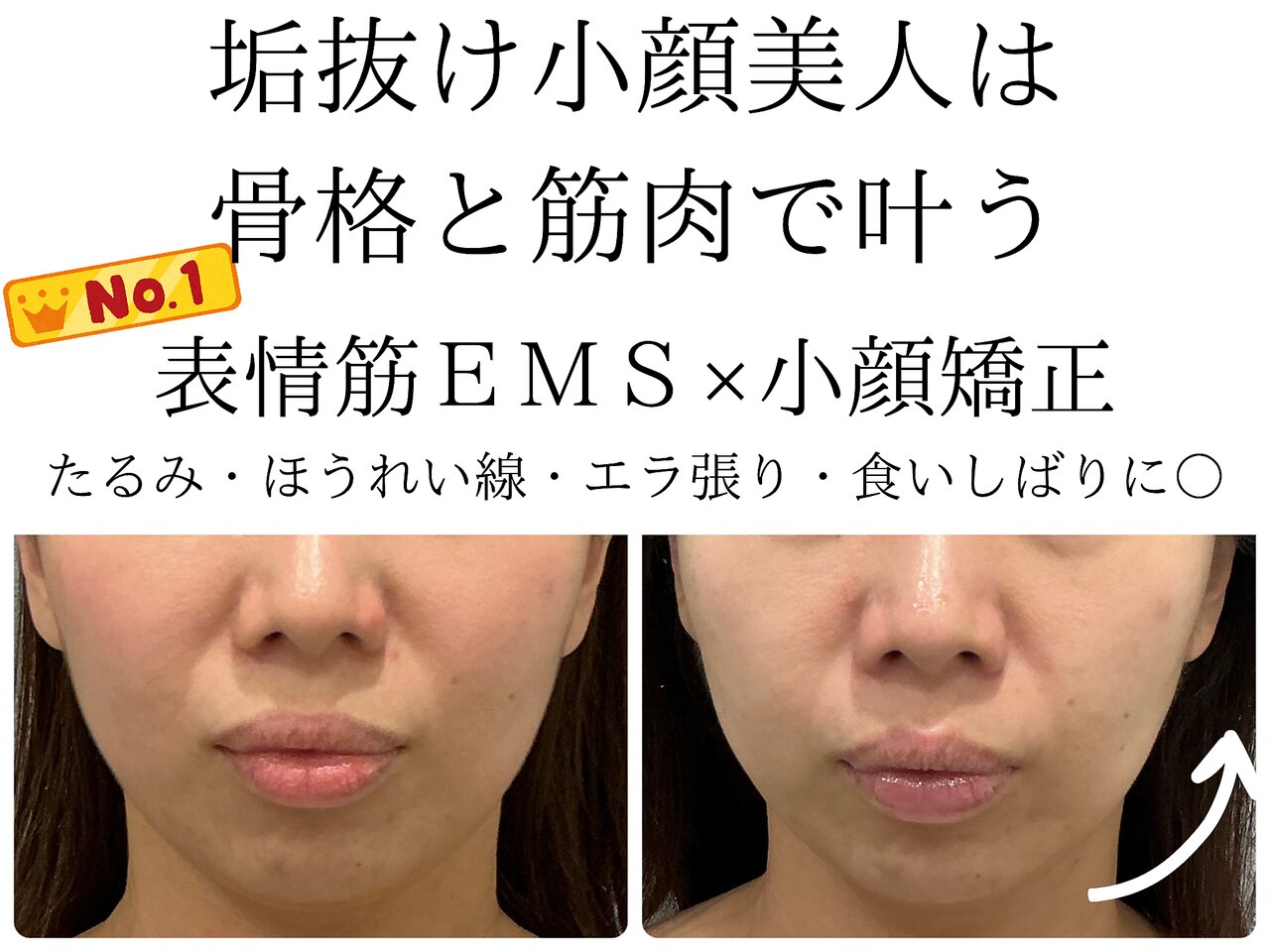 値下げしました！エステサロン　EMS 広島市中区でEMSが人気のエステサロン｜ホットペッパービューティー ボディ・フェイスケア