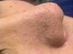 ビューティーバーコア(Beauty bar KOA)の写真/《人気No1☆頑固な毛穴汚れをごっそり除去》毛穴に詰まった汚れや黒ずみを大掃除！
