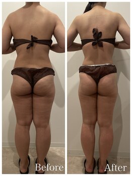 まろん鍼灸接骨院 立川店/痩身エステ（下半身）