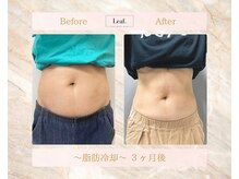 リーフ(Leaf.)/脂肪冷却ダイエット