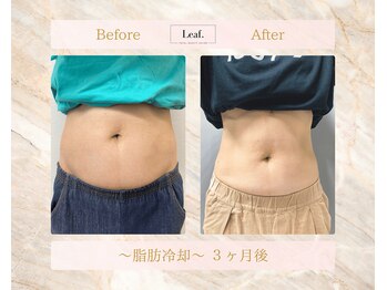リーフ(Leaf.)/脂肪冷却ダイエット