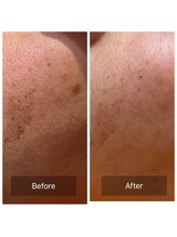 ハドゥ(Ha-DU)/シミケア20分間コース