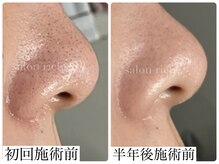 サロンリシェ(salon riche)の雰囲気（【20代女性】黒ずみ・化粧崩れ/6ヶ月/エステ9回＋ホームケア）