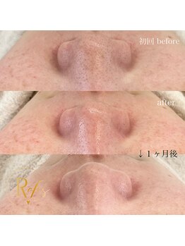 ラヴィス(RAVIS)/大人気ハイドロ毛穴洗浄