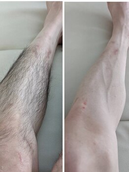 長寿鍼灸院 長寿整骨院/★全身つるスベ宣言★