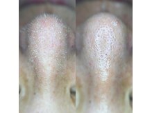 アモリアージュ(Amolliage)の雰囲気（韓国式3D毛穴洗浄！小鼻の黒ずみや、角栓などを浮き出します!）