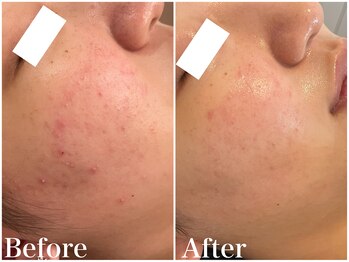 サロンドフェイス(Salon de Faith)/ハーブピーリング