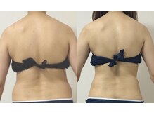 プリマルーチェ/プレミアム背中プログラム