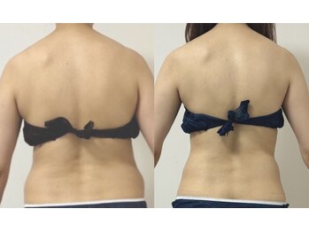 プリマルーチェ/プレミアム背中プログラム