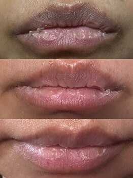 フェリス(FELIZ)/サロンケアで明るい口元