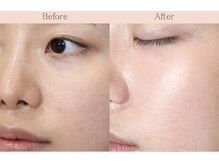 エステリジュランbefore⇒after☆くすみがちな肌に栄養補給！