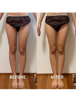 ブルーム(BLOOM)/O脚気味の足から美脚へ