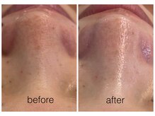 ハリスキンラボ(Hari.Skin.Lab)/20代のお客様/1回の施術効果