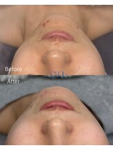 オン(on.)/メソプロ施術3週間後