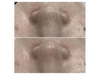 シェーン(Schon)/美肌光フォト《お鼻》