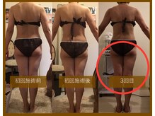 サロンドボーテ ヴィクトワール マルヤマ(Salon de beaute VICTOIRE MARUYAMA)/キャビテーション【w1回ペース】