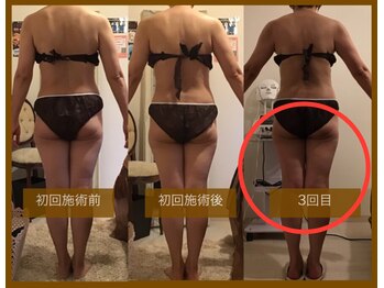 サロンドボーテ ヴィクトワール マルヤマ(Salon de beaute VICTOIRE MARUYAMA)/キャビテーション【w1回ペース】