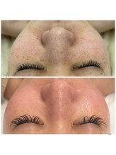 クレア(Clair)/オーダーメイド肌質改善1年