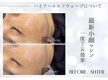 ユアーズ ビューティー(YOURS beauty)/1回で驚きの小顔へ☆