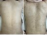 《当店1番人気》背中のニキビケア・黒ずみ改善短期間集中コース【初回体験】
