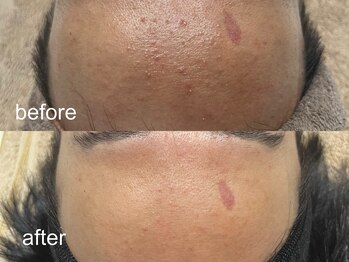 エムフロート(M float)/ハーブピーリング|ニキビ