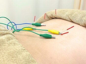アポロ鍼灸マッサージ接骨院の写真/美容鍼・鍼灸で根本改善◎お客様に合わせたオーダーメイド施術ご提案♪継続することで効果UP!男性にも人気!