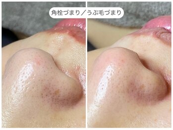 フラックス 京都(FLUX)/【エンビロン】毛穴集中コース