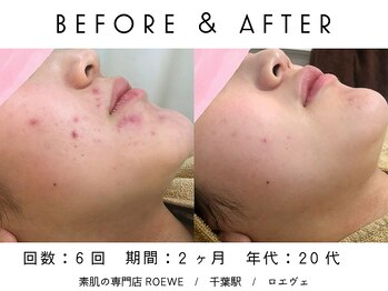 ロエヴェ(ROEWE)/ニキビ改善・毛穴ケア・肌質改善