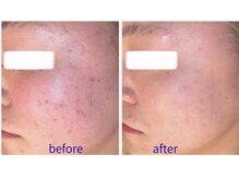 ビオール 池袋店(beall)/全顔丸ごとフェイシャルコース