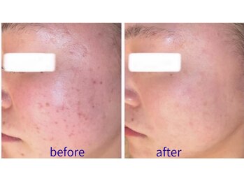 ビオール 池袋店(beall)/全顔丸ごとフェイシャルコース