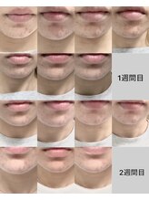 アンフィニ(Infini)/プラズマ×MBFF徹底ニキビ肌改善